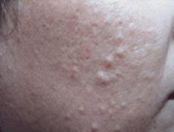 Что такое кальциноз кожи (calcinosis cutis)